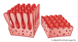 Schematische Darstellung der Dünndarmzottenatrophie bei Zöliakie. © wildpixel/iStock/Getty Images Plus Schematische Darstellung der Dünndarmzottenatrophie bei Zöliakie. © wildpixel/iStock/Getty Images Plus