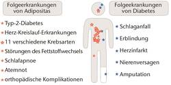 Mögliche Folgeerkrankungen von Adipositas und Diabetes mellitus. © UZV Mögliche Folgeerkrankungen von Adipositas und Diabetes mellitus. © UZV