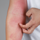 Ernährung bei Neurodermitis (atopische Dermatitis)