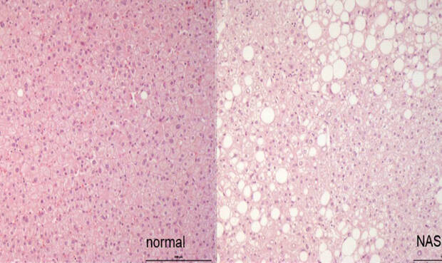 Leberbiopsien mit verschiedenem Grad der Leberfettansammlung